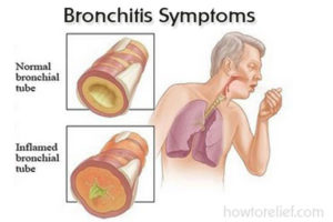 Bronchitis Symptoms
