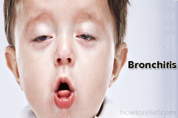 Bronchitis