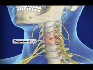 Cervical Spondylosis