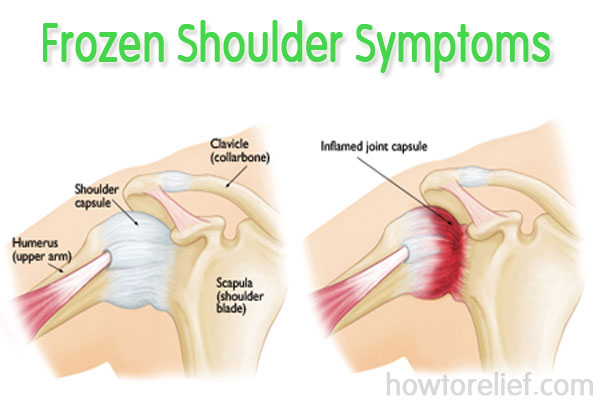 Frozen Shoulder Symptoms