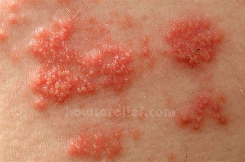 Shingles Symptom