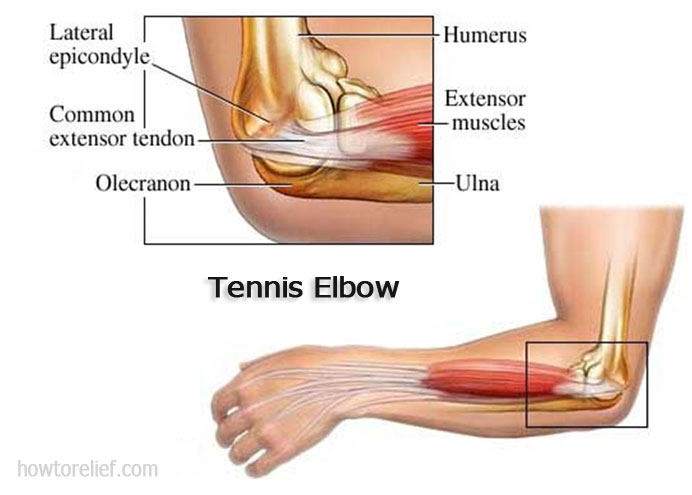 Tennis Elbow Symptom