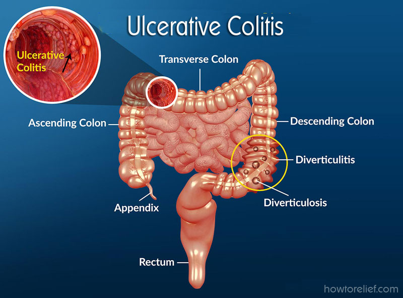 presentation of ulcerative colitis