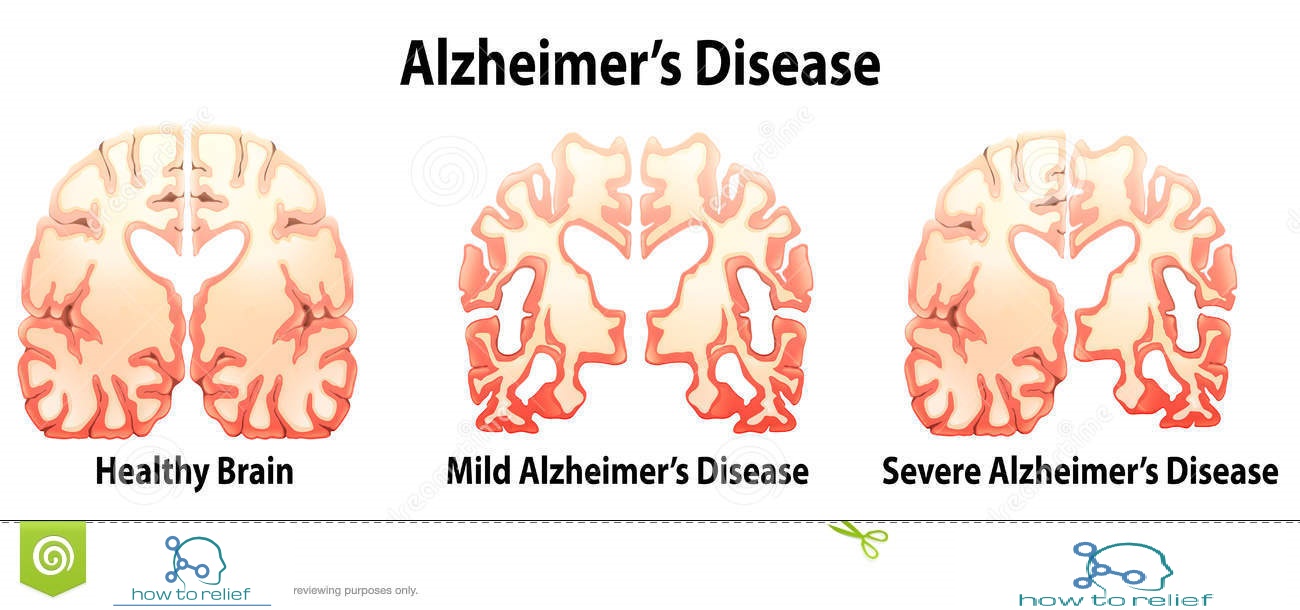 alzheimer’s disease