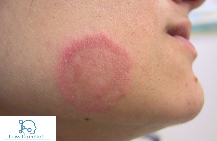 Ringworm