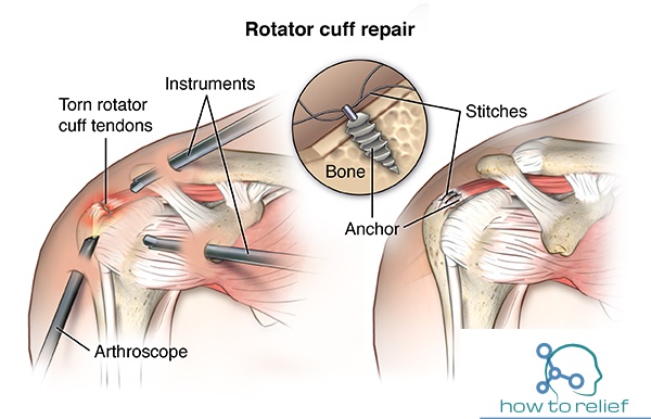 Rotator Cuff Repair