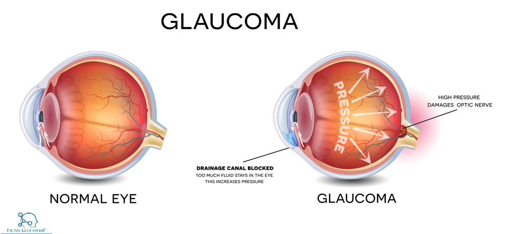 glaucoma