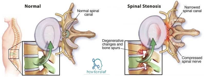 Symptoms of Spinal Stenosis