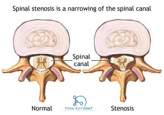 spinal stenosis