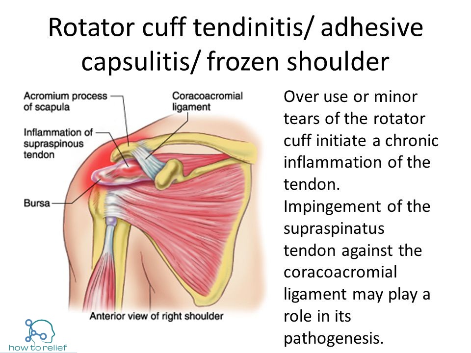 rotator cuff vs frozen shoulder