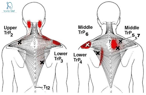 trapezius trigger point
