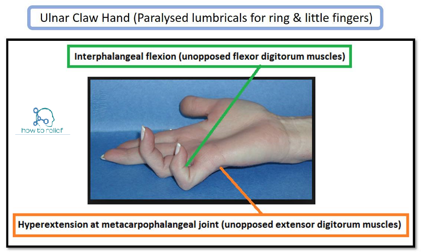 ulnar claw