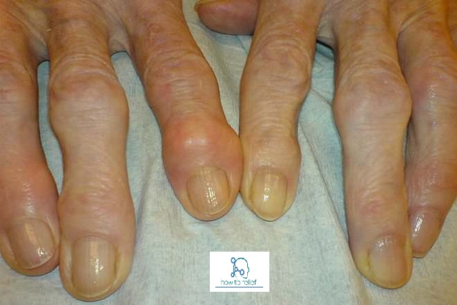 Rheumatoid Arthritis treatment