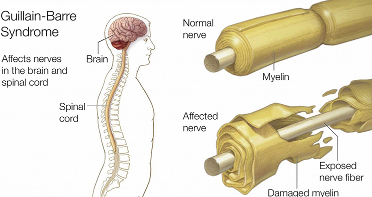 causes of Guillain Barre Syndrome