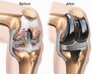 Knee Replacement Surgery procedure