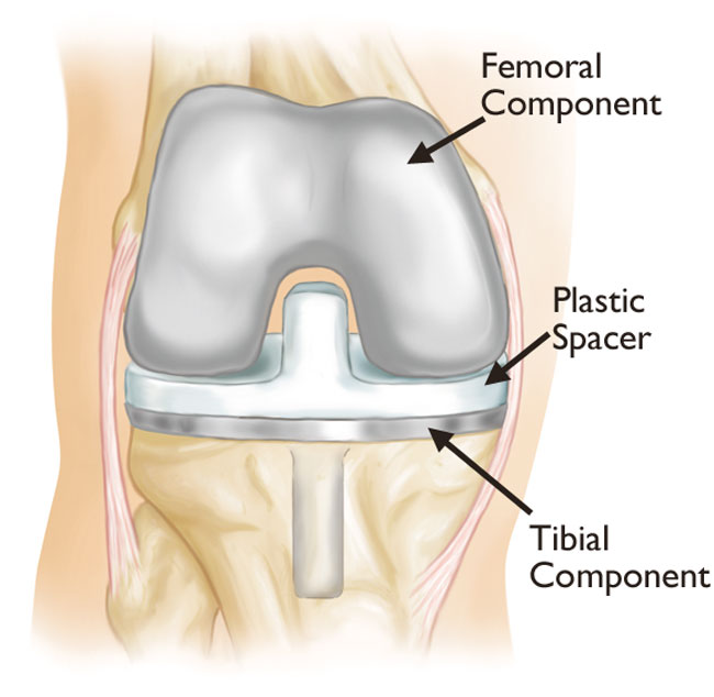 Knee Replacement Surgery