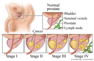 stages of prostate cancer