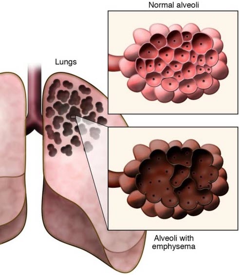 Lung Anatomy Emphysema