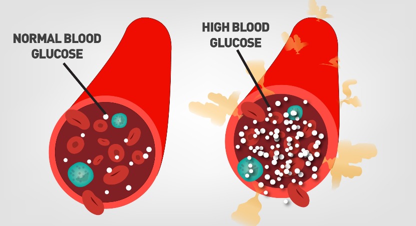 Hyperglycemia-high blood sugar