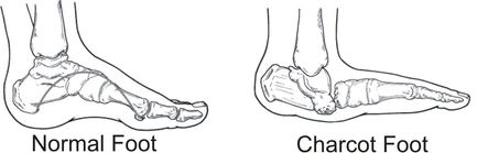 charcot-foot-Charcot-Arthropathy