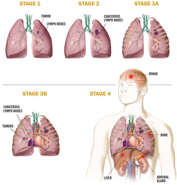 lung cancer stages