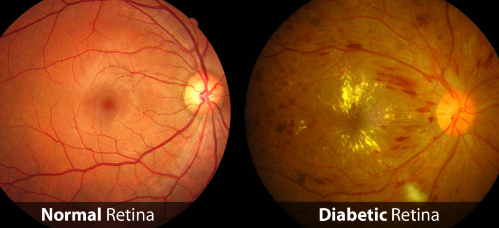 Diabetic-Retinopathy