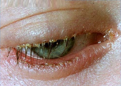 Blepharitis symptoms