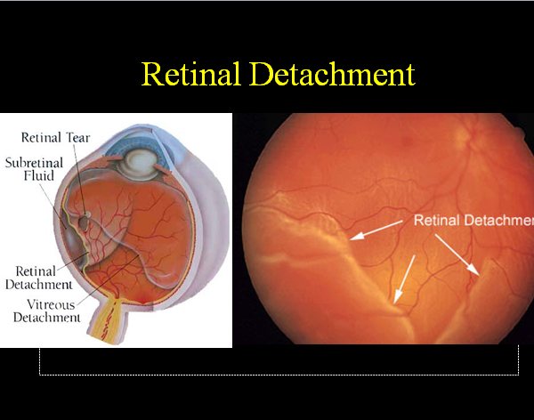 retinal detachment