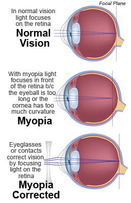 kezelje a szemeket myopia