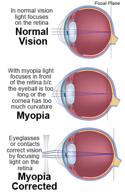 Nearsightedness