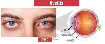 uveitis