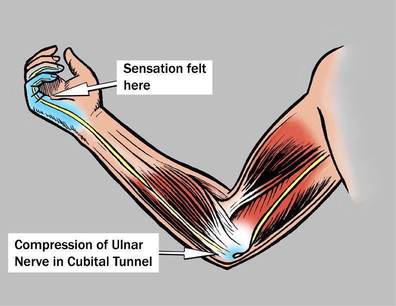 radial tunnel syndrome home treatment