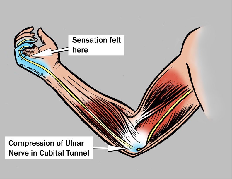 Cubital tunnel syndrome pain