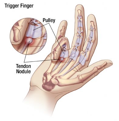 Trigger Finger Causes
