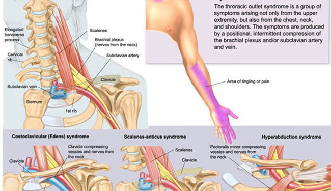 syndrome of thoracic outlet