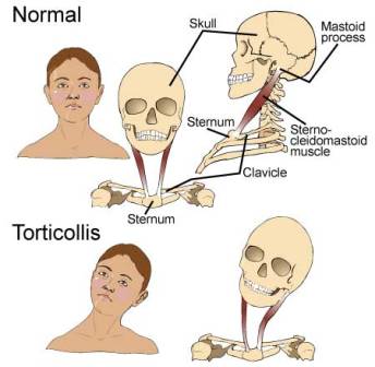 torticollis symptoms