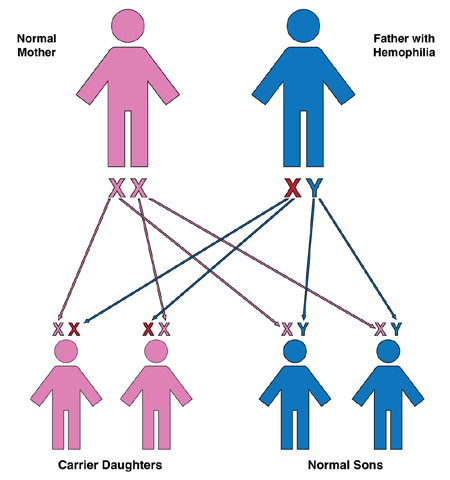 hemophilia causes