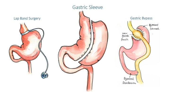 Gastric Sleeve Surgery