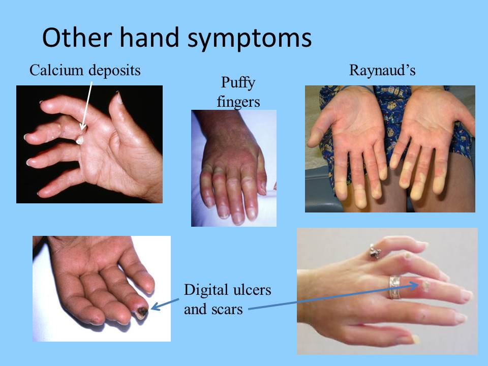 Scleroderma treatment