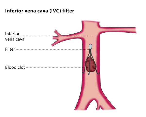 ivc filter placement