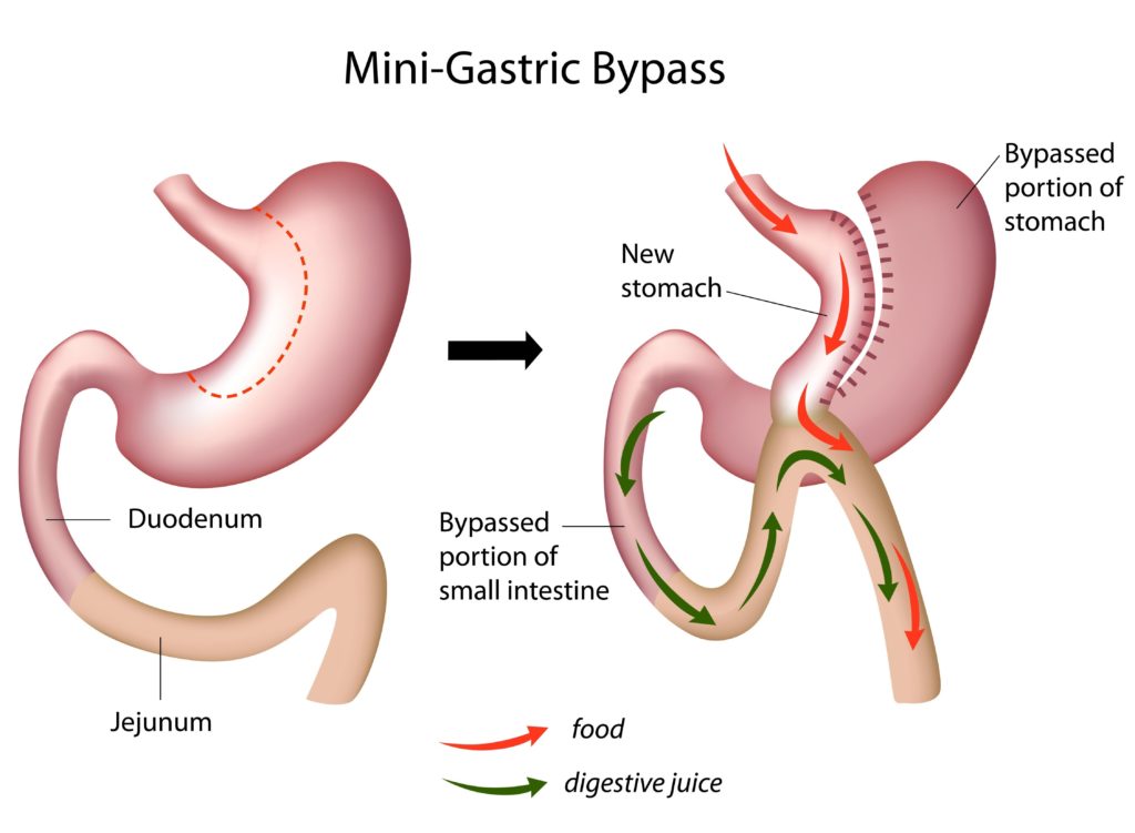 mini gastric bypass