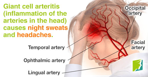 Giant Cell Arteritis