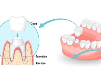 How Much is a Root Canal and Crown Without Insurance